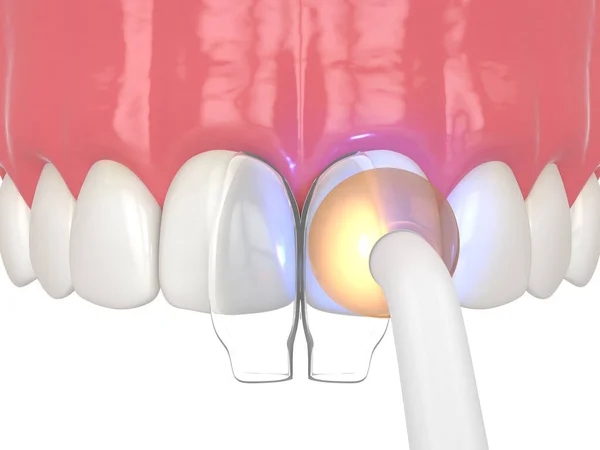 Dental Bonding - 360 Global Health Solutions
