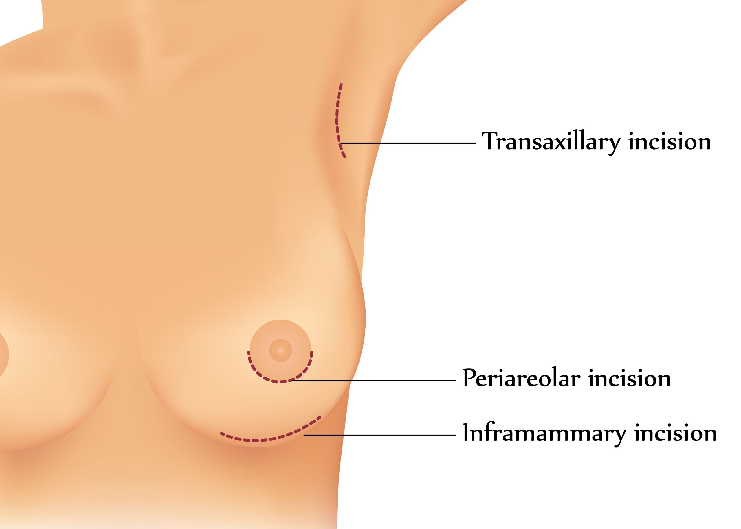 Breast Augmentation - 360 Global Health Solutions