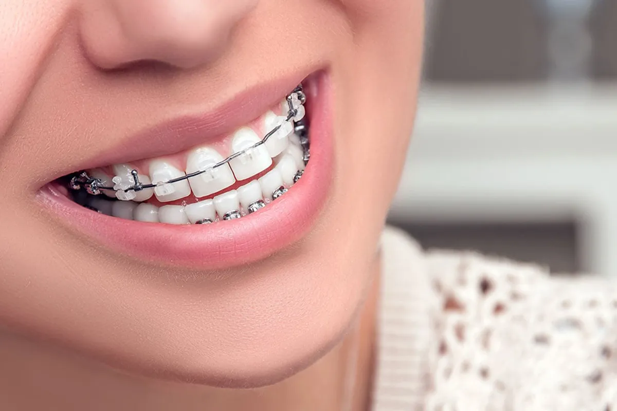 Braces - 360 Global Health Solutions