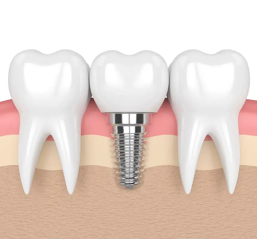 Dental Implants - 360 Global Health Solutions