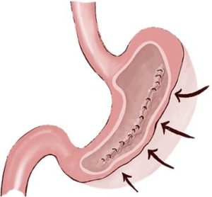 Endoscopic Sleeve Gastroplasty - 360 Global Health Solutions
