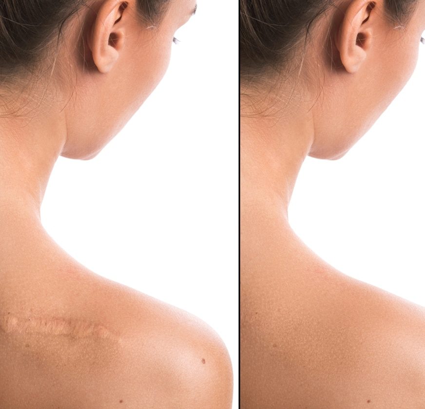Scar Revision Surgery - 360 Global Health Solutions