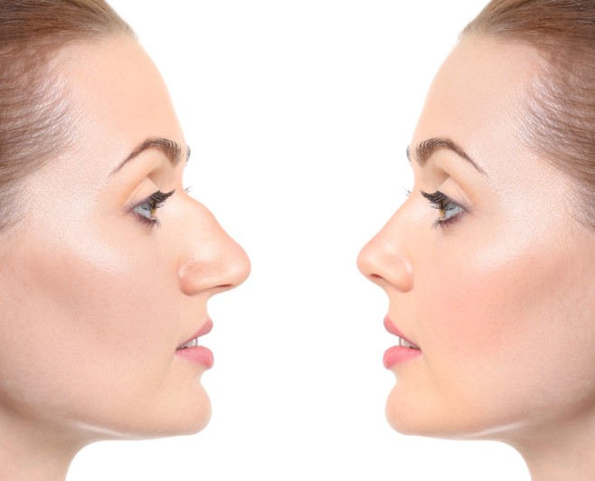 Rhinoplasty - 360 Global Health Solutions