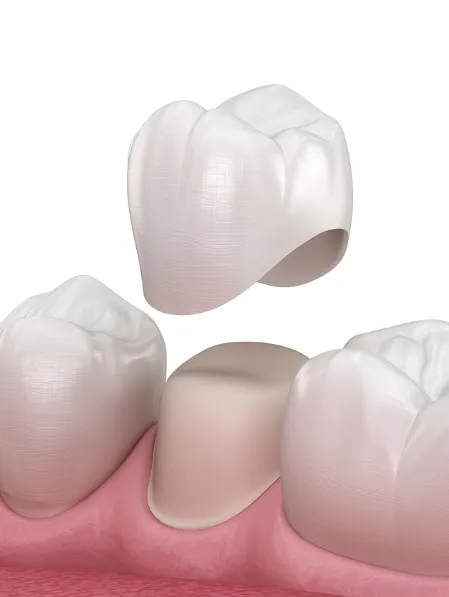 Dental Crowns - 360 Global Health Solutions