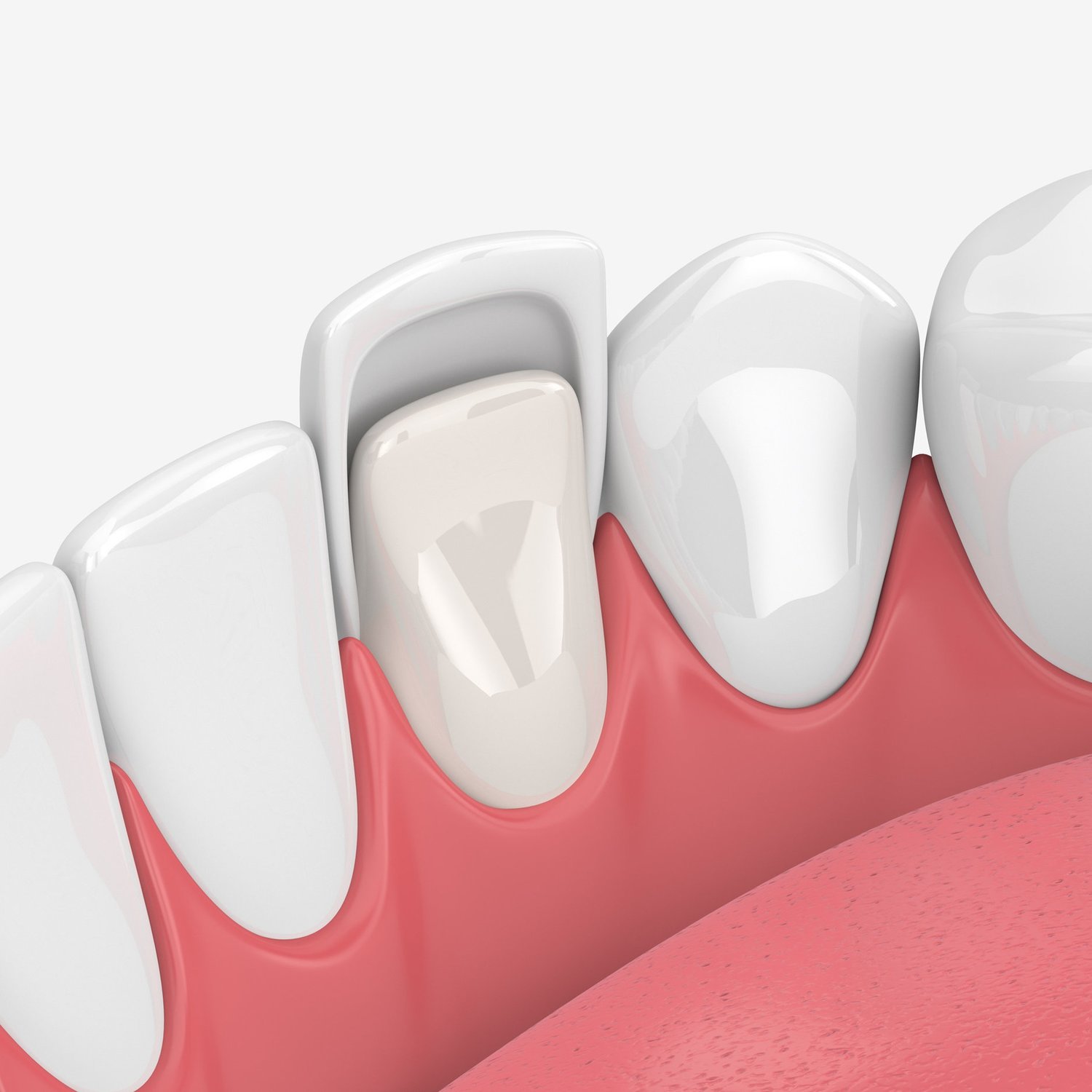 Veneers - 360 Global Health Solutions