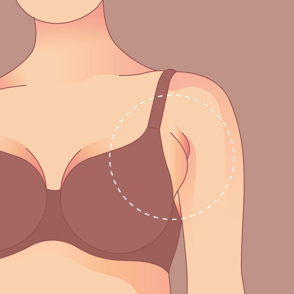 Breast Reduction - 360 Global Health Solutions