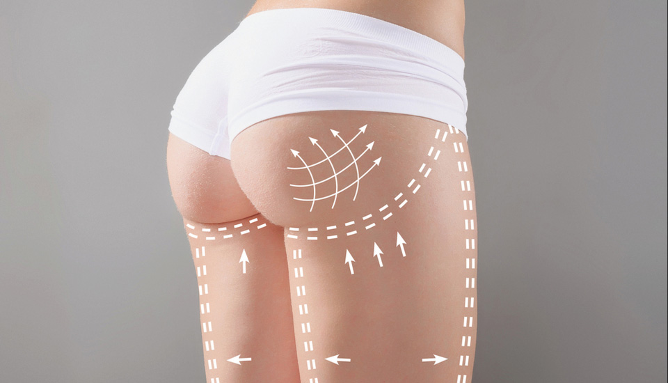 Fat Grafting - 360 Global Health Solutions