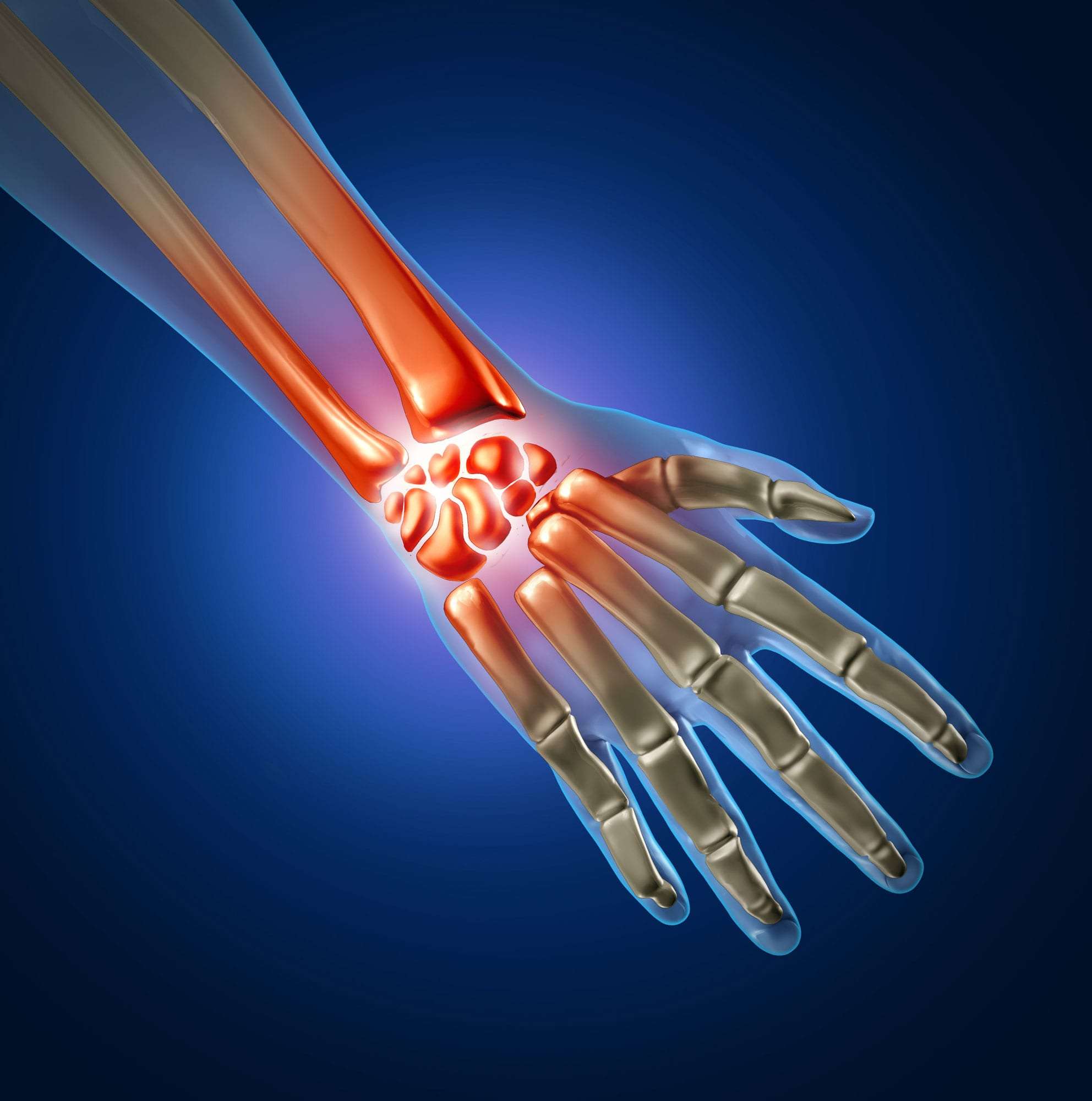 Carpal Tunnel Surgery - 360 Global Health Solutions