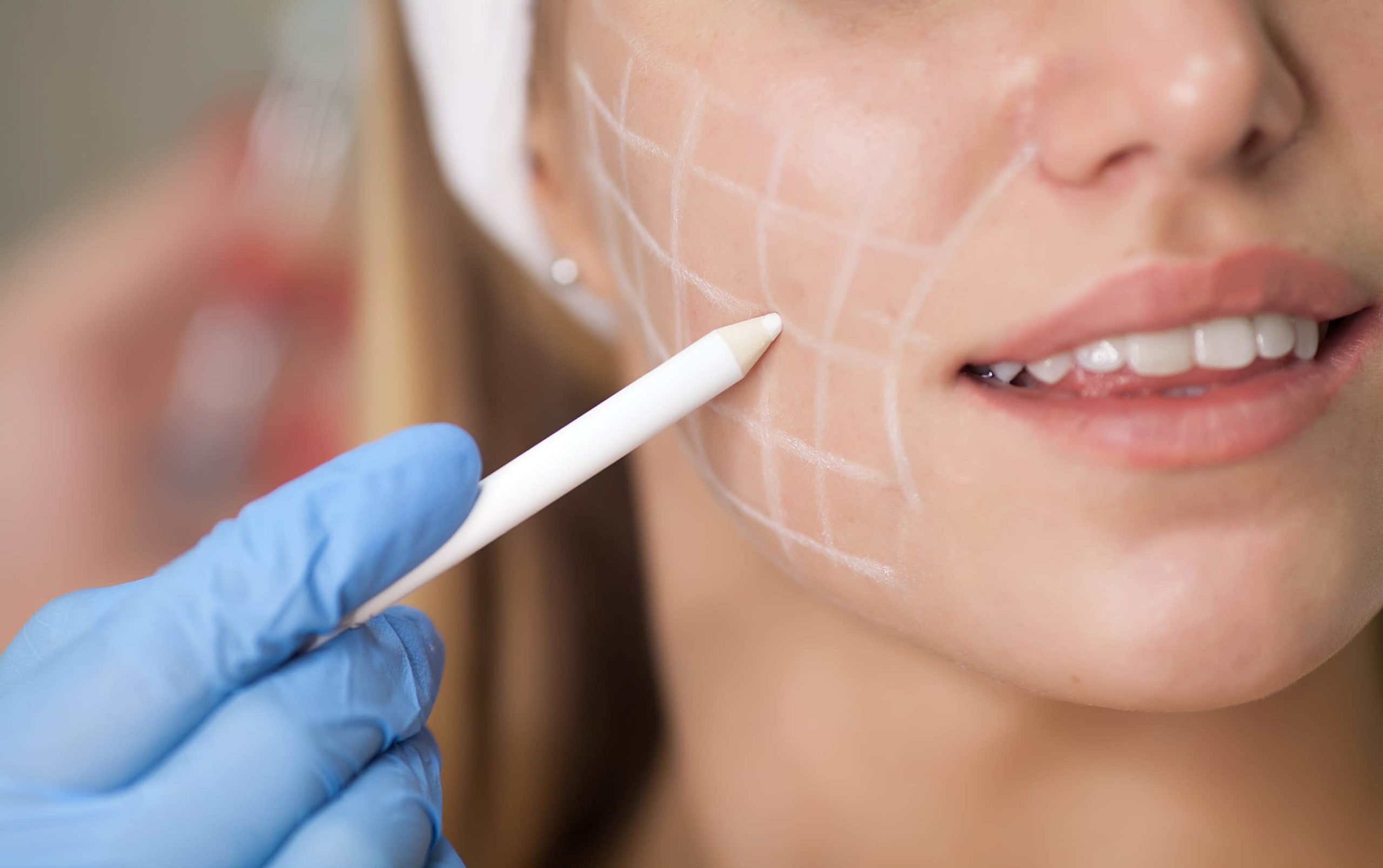 Cheek Augmentation - 360 Global Health Solutions