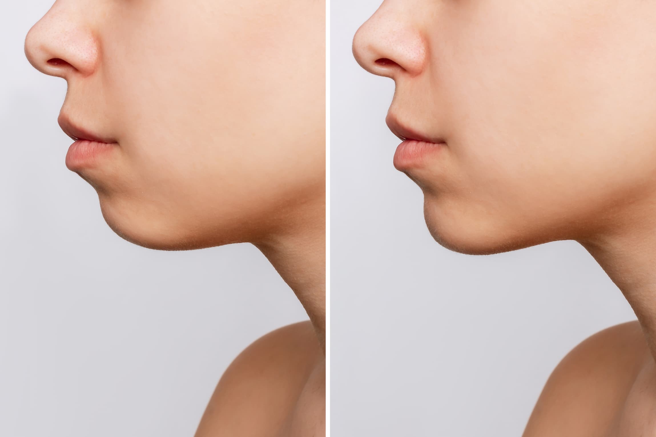 Chin Augmentation - 360 Global Health Solutions