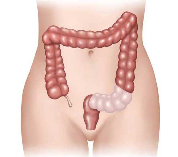 Prophylactic Colectomy - 360 Global Health Solutions