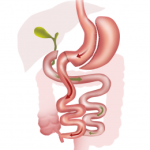 Biliopancreatic Diversion With Duodenal Switch - 360 Global Health Solutions
