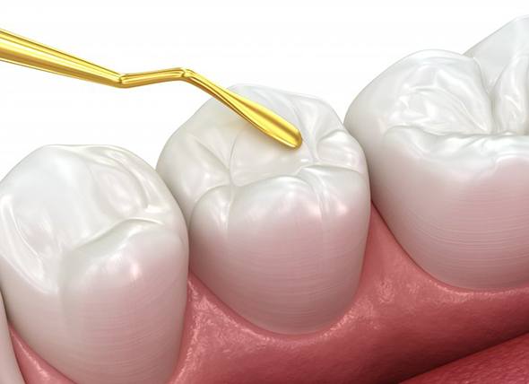 Tooth Colored Fillings - 360 Global Health Solutions