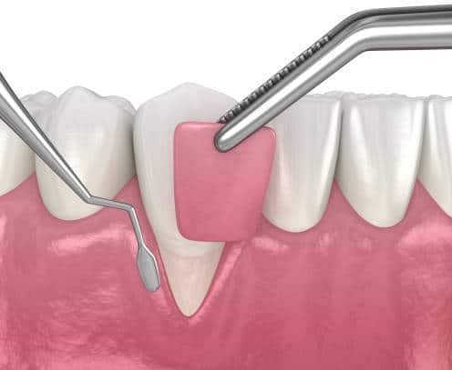 Gum Contouring - 360 Global Health Solutions