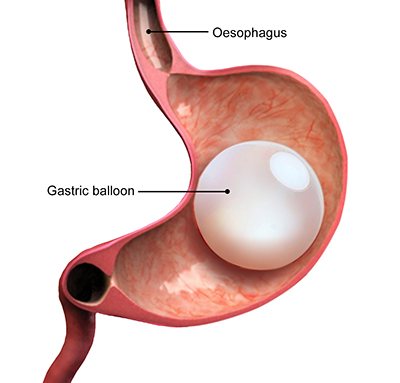 Gastric Balloon - 360 Global Health Solutions