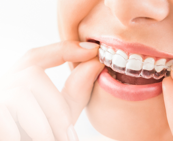 Invisalign - 360 Global Health Solutions