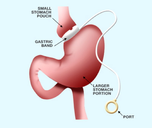 Adjustable Gastric Banding - 360 Global Health Solutions