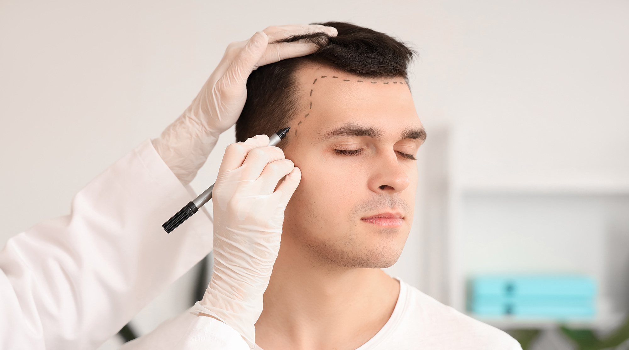 Hair Transplant - 360 Global Health Solutions