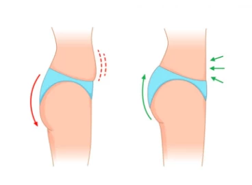 Buttock Augmentation - 360 Global Health Solutions