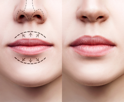 Lip Augmentation - 360 Global Health Solutions