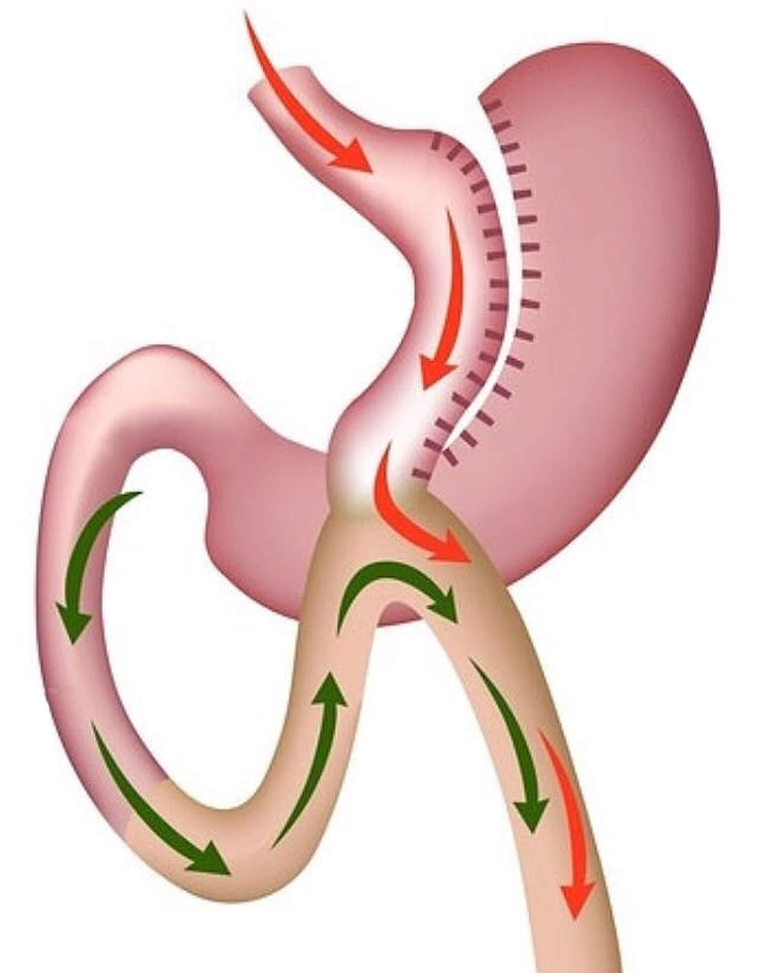 Mini Gastric Bypass - 360 Global Health Solutions