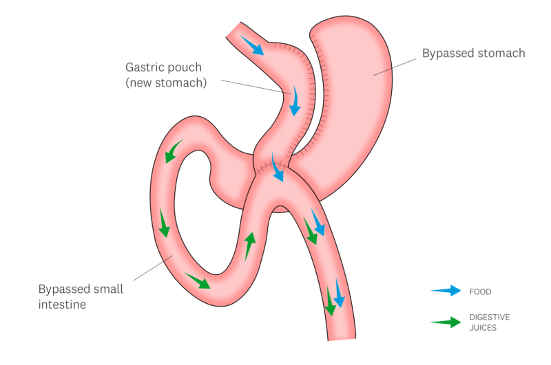 Gastric Bypass Surgery - 360 Global Health Solutions