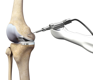 Robotic Knee Replacement Surgery - 360 Global Health Solutions