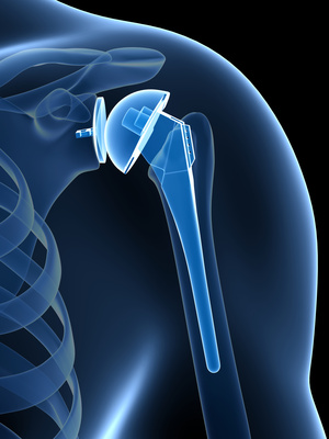 Shoulder Replacement Surgery - 360 Global Health Solutions