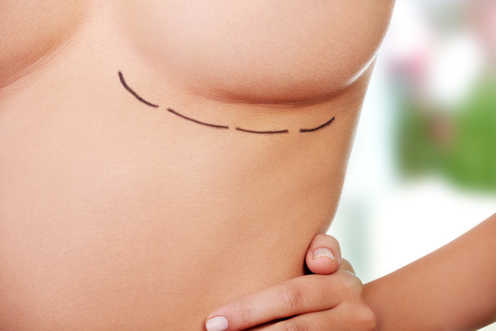 Prophylactic Mastectomy - 360 Global Health Solutions