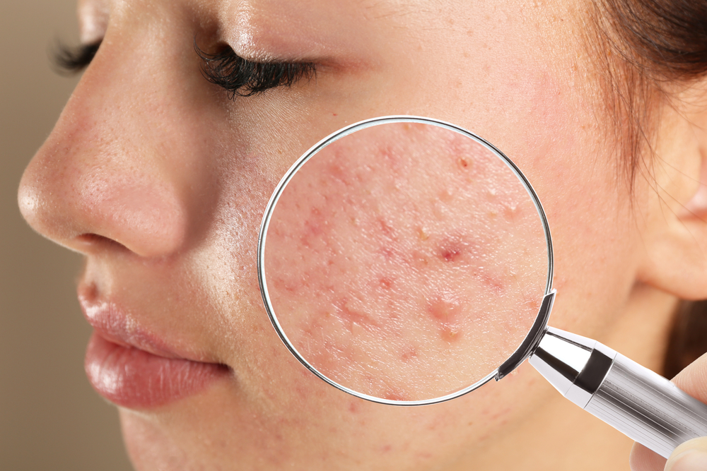 Acne Scar Treatments - 360 Global Health Solutions