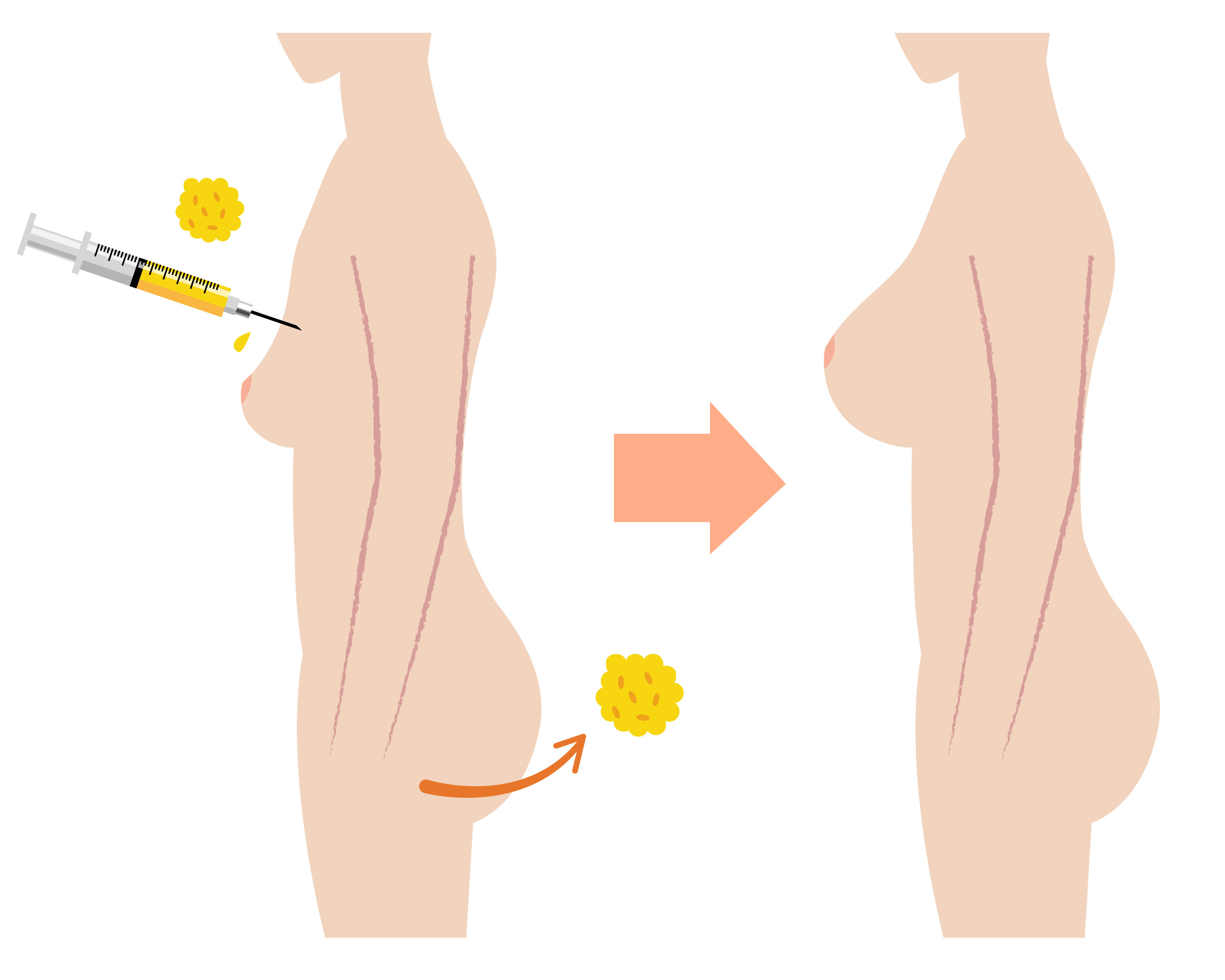 Fat Transfer Breast Augmentation - 360 Global Health Solutions