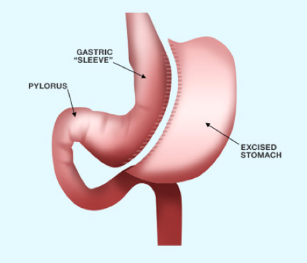 Sleeve Gastrectomy - 360 Global Health Solutions