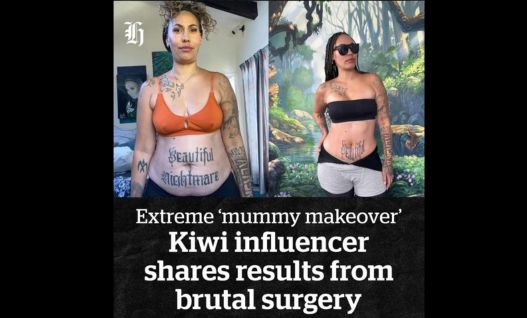 Nicola ‘Nix’ Adams shares dramatic before and after photos of ‘mummy makeover’ surgery