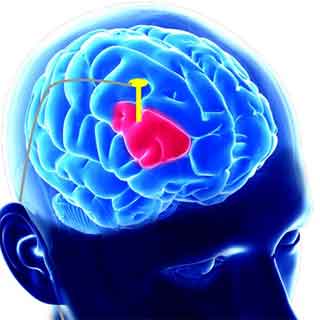 Deep Brain Stimulation Treatment - 360 Global Health Solutions