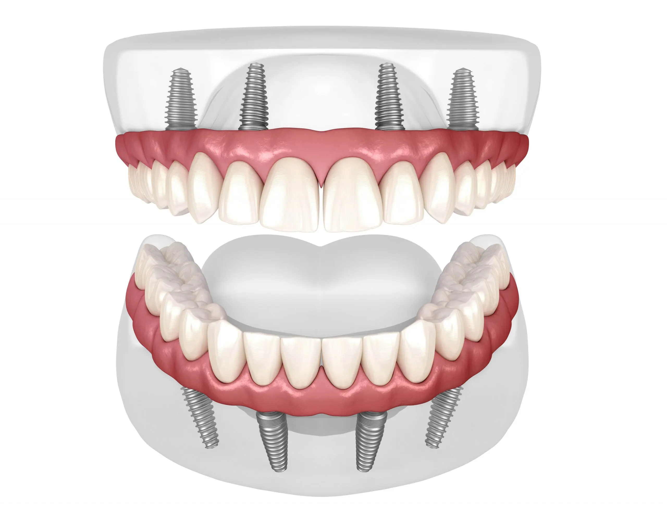 4 Dental Implant - 360 Global Health Solutions