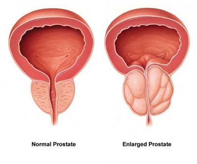 Robotic Prostate Surgery - 360 Global Health Solutions