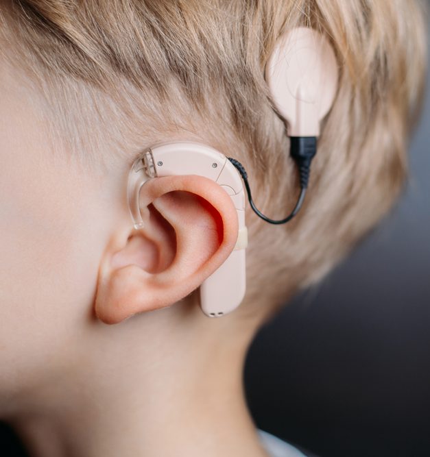 Cochlear Implant - 360 Global Health Solutions